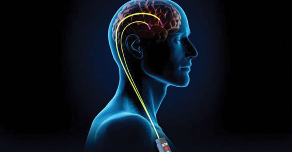 Cirurgia para distonia