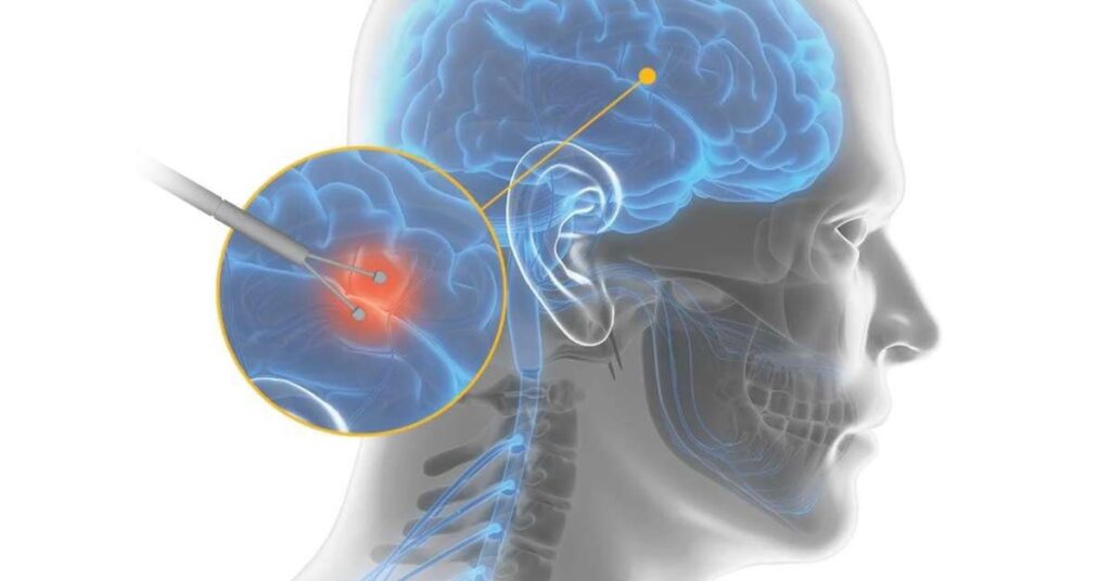 MICRO REGISTRO CEREBRAL